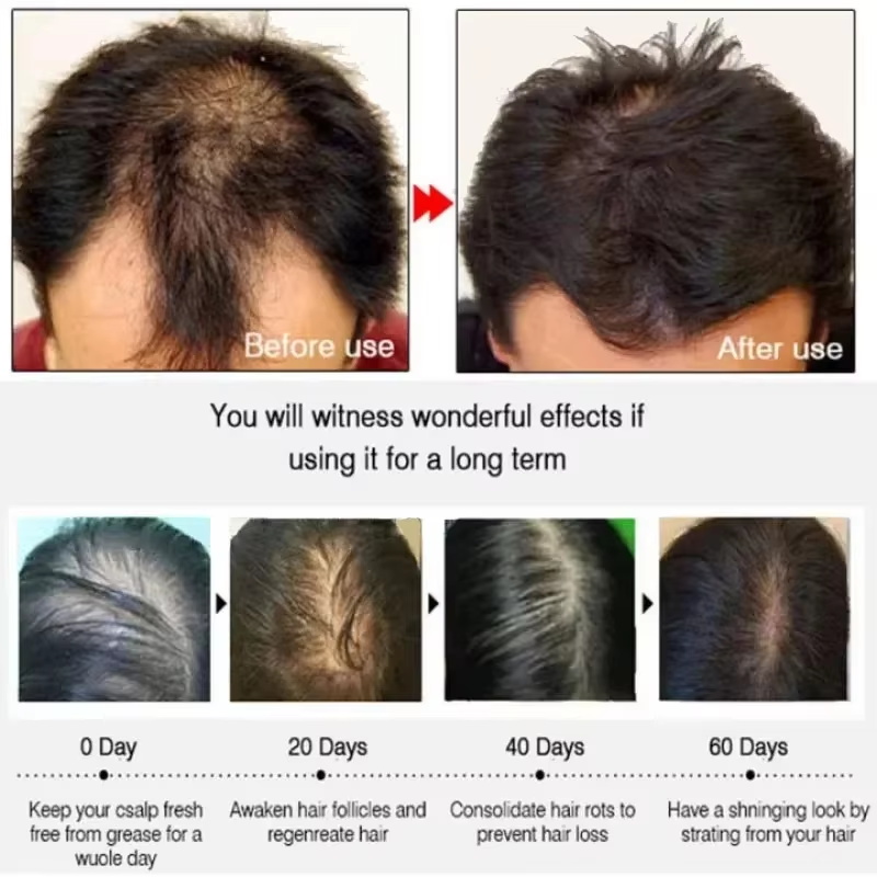 育毛血清 7 日間高速再生エッセンシャルカプセル抗脱毛ハゲ修 - Epidermal Growth Factor のレビューと価格